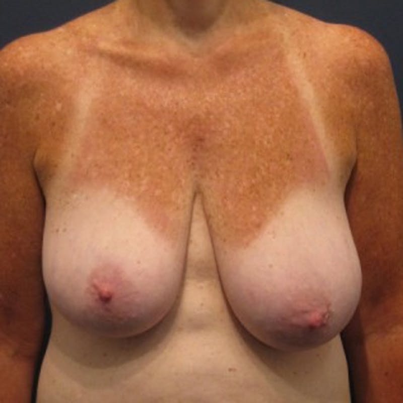 Breast Lift Before & After Gallery - Patient 174146621 - Image 1