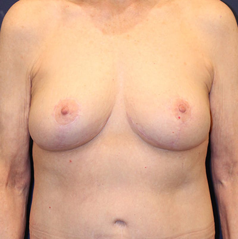 Breast Lift Before & After Gallery - Patient 174147700 - Image 2