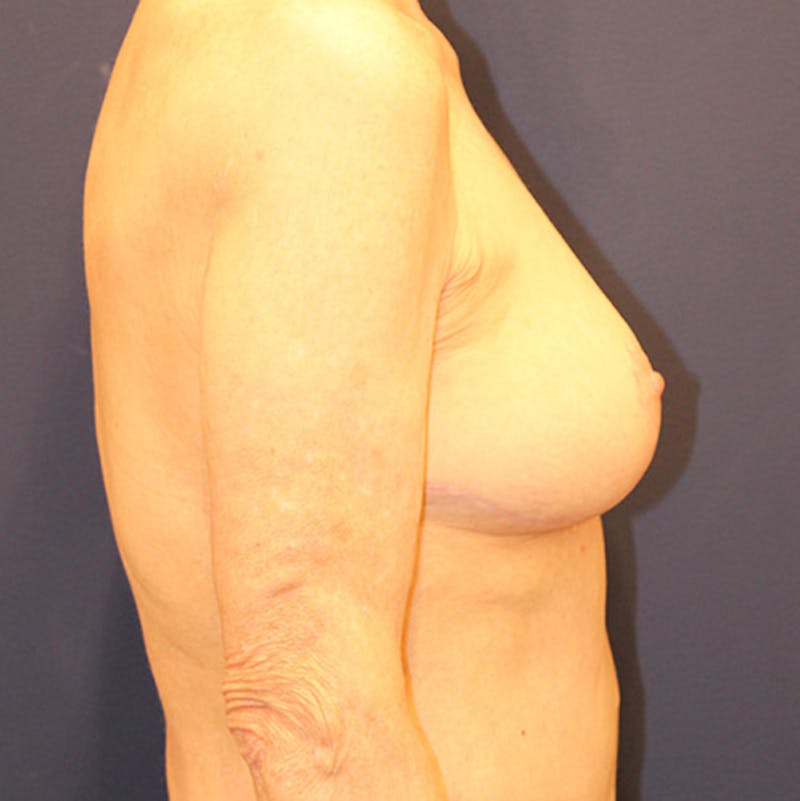 Breast Lift Before & After Gallery - Patient 174147700 - Image 6