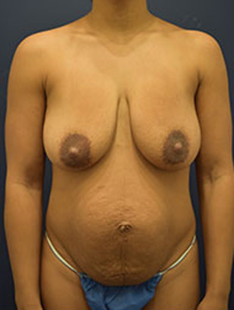 Breast Lift Before & After Gallery - Patient 174147706 - Image 1