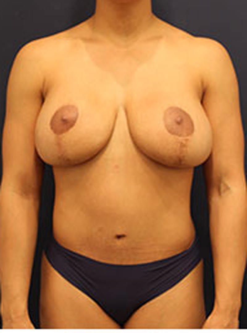 Breast Lift Before & After Gallery - Patient 174147706 - Image 2