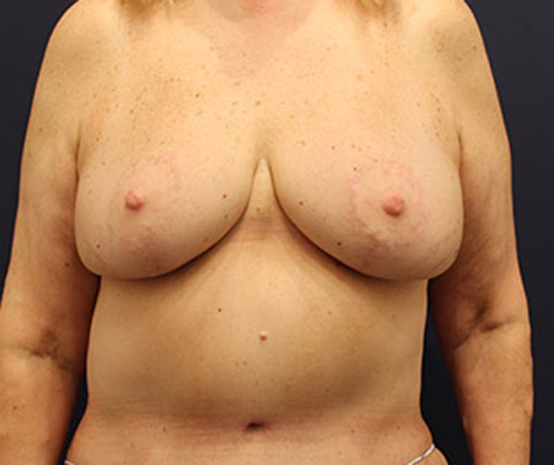 Breast Lift Before & After Gallery - Patient 174147711 - Image 2