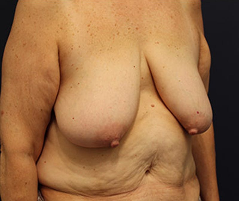 Breast Lift Before & After Gallery - Patient 174147711 - Image 3