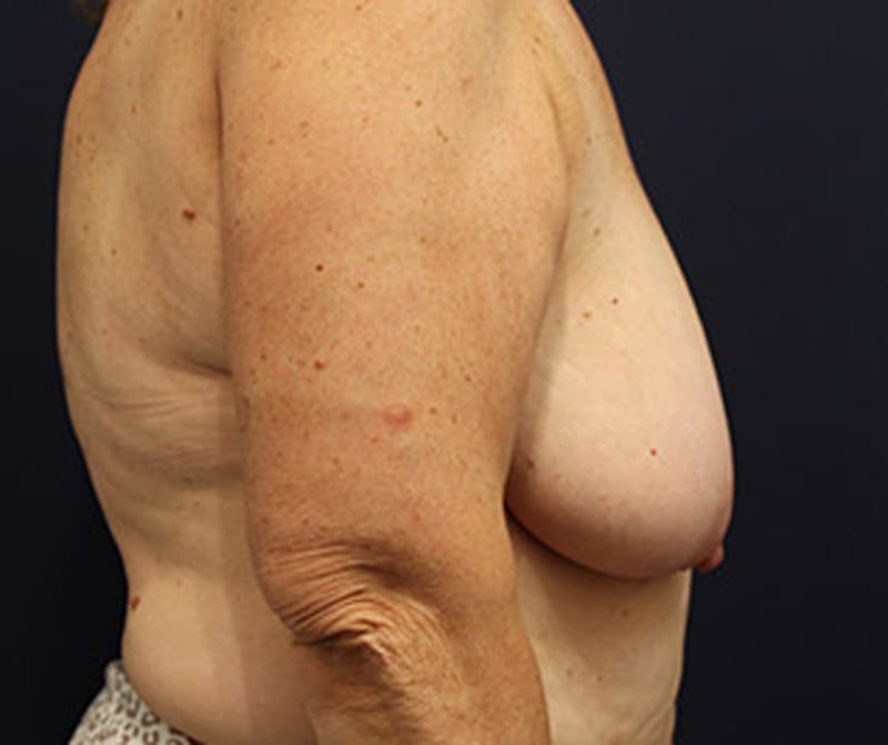 Breast Lift Before & After Gallery - Patient 174147711 - Image 5