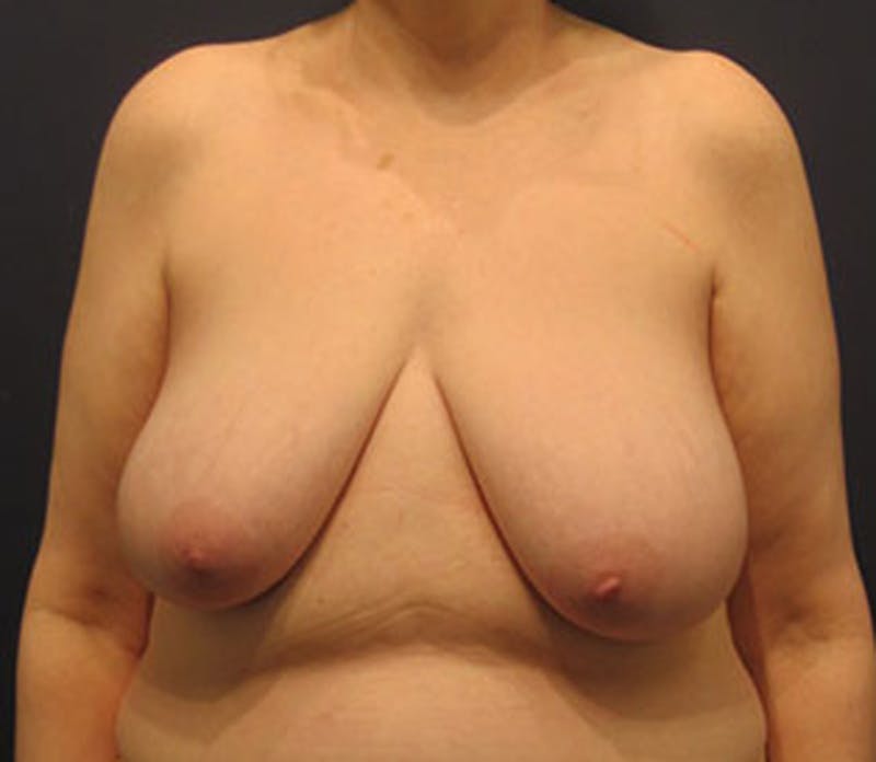 Breast Lift Before & After Gallery - Patient 174147718 - Image 1