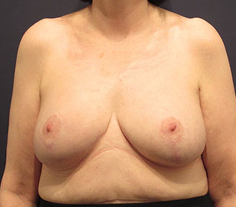 Breast Lift Before & After Gallery - Patient 174147718 - Image 2