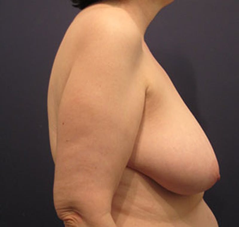 Breast Lift Before & After Gallery - Patient 174147718 - Image 5