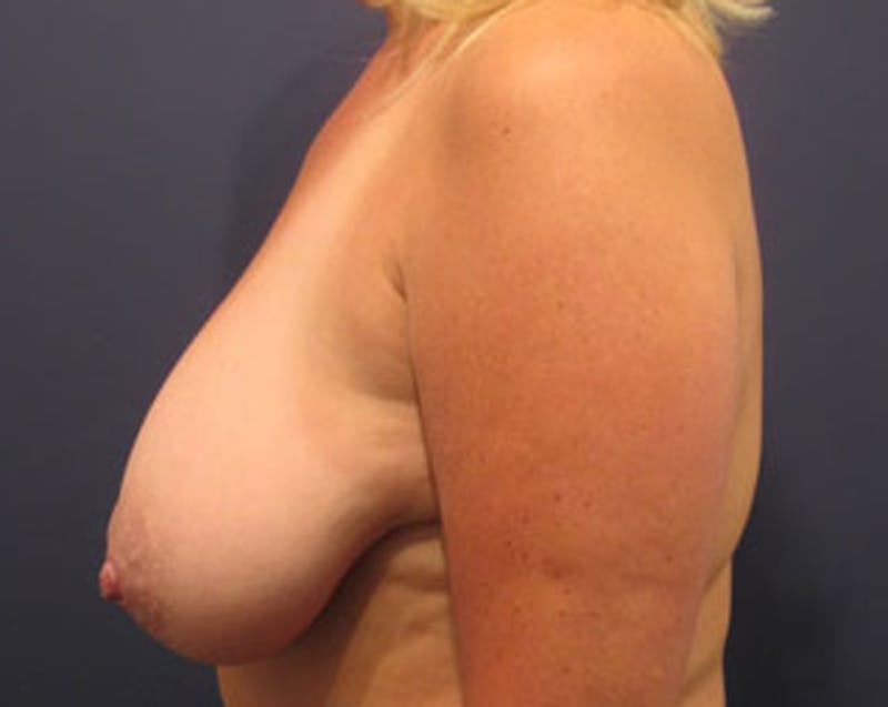 Breast Lift Before & After Gallery - Patient 174147792 - Image 5