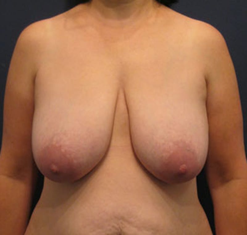 Breast Lift Before & After Gallery - Patient 174148868 - Image 1