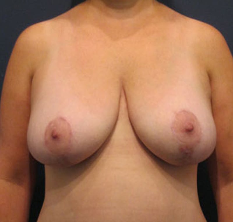 Breast Lift Before & After Gallery - Patient 174148868 - Image 2