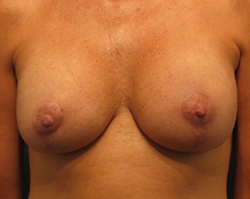 Breast Lift Before & After Gallery - Patient 174148877 - Image 2