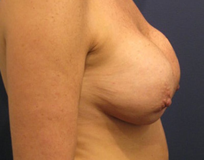 Breast Lift Before & After Gallery - Patient 174148877 - Image 5