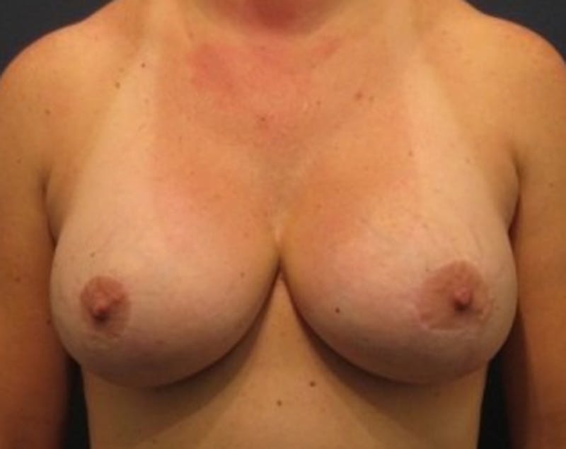 Breast Lift Before & After Gallery - Patient 174148880 - Image 2