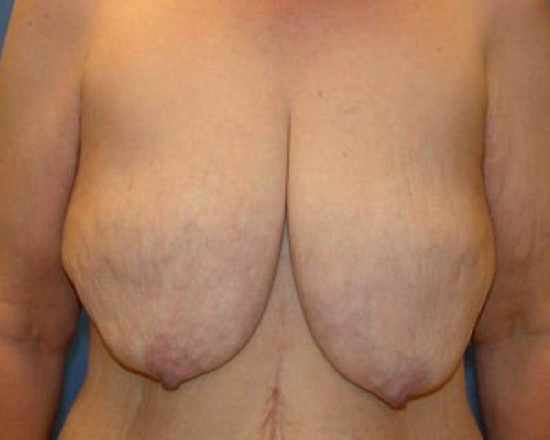 Breast Lift Before & After Gallery - Patient 174148887 - Image 1