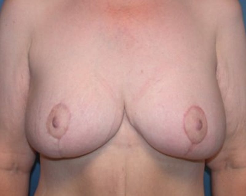 Breast Lift Before & After Gallery - Patient 174148887 - Image 2