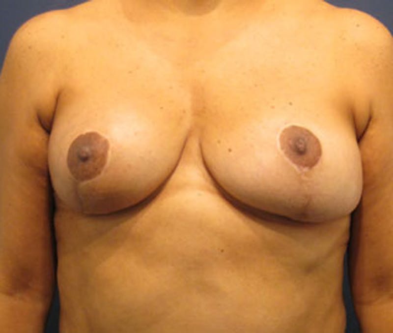 Breast Lift Before & After Gallery - Patient 174149972 - Image 2