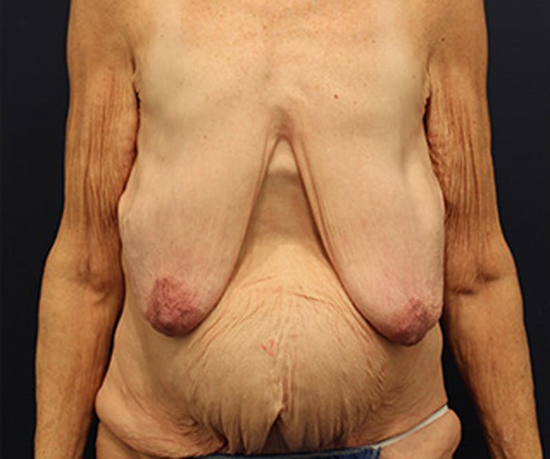 Breast Lift Before & After Gallery - Patient 174149980 - Image 1