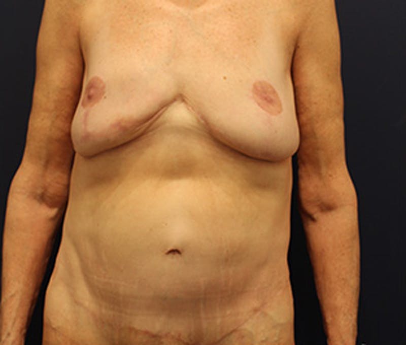 Breast Lift Before & After Gallery - Patient 174149980 - Image 2