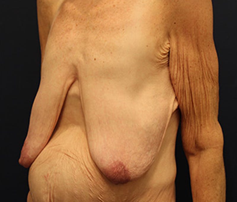 Breast Lift Before & After Gallery - Patient 174149980 - Image 3