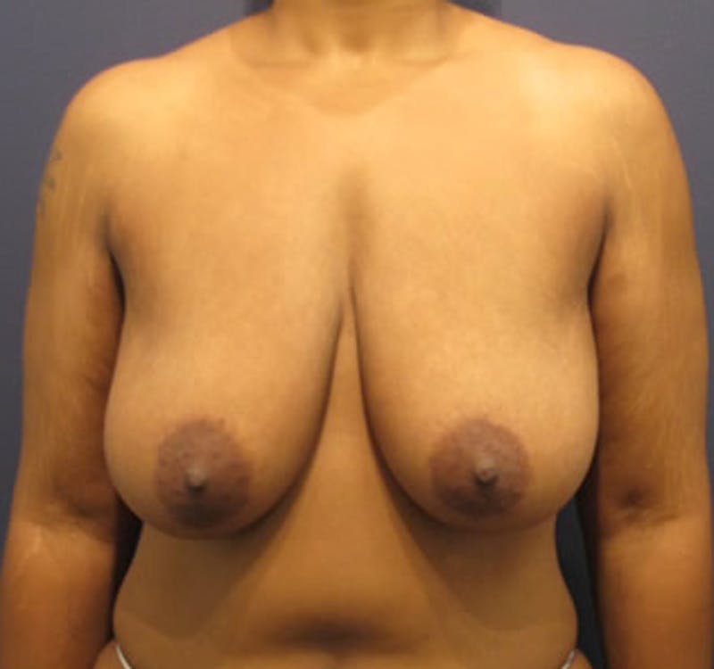 Breast Lift Before & After Gallery - Patient 174149986 - Image 1