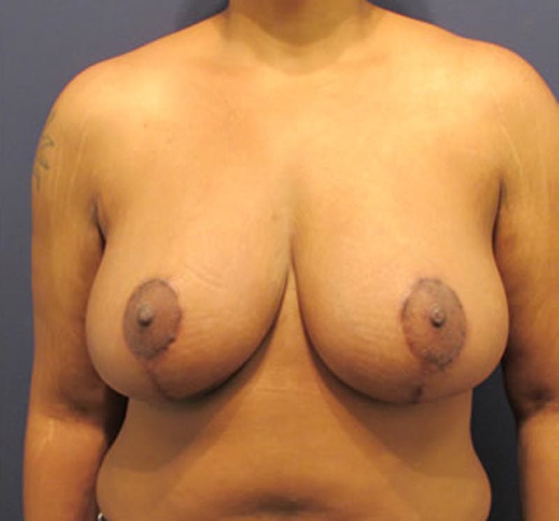 Breast Lift Before & After Gallery - Patient 174149986 - Image 2