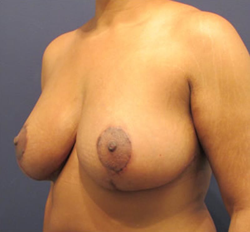 Breast Lift Before & After Gallery - Patient 174149986 - Image 4
