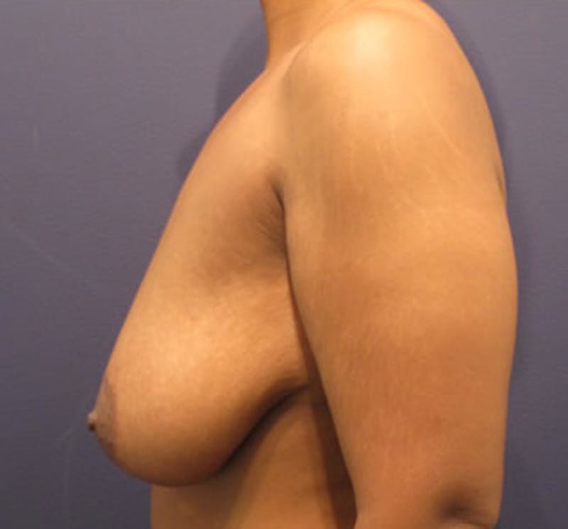 Breast Lift Before & After Gallery - Patient 174149986 - Image 5
