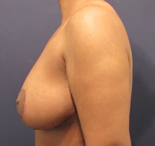 Breast Lift Before & After Gallery - Patient 174149986 - Image 6