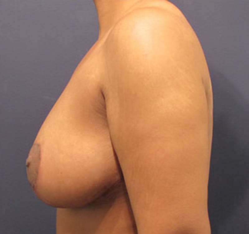 Breast Lift Before & After Gallery - Patient 174149986 - Image 6