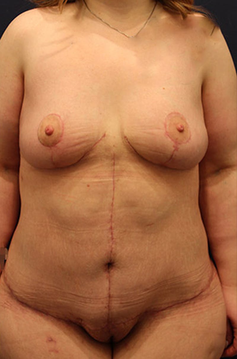 Breast Lift Before & After Gallery - Patient 174150004 - Image 2