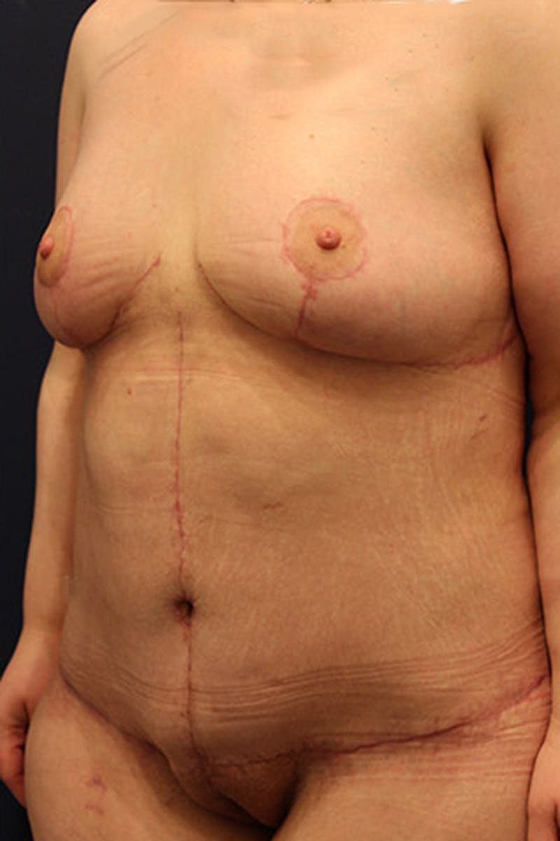 Breast Lift Before & After Gallery - Patient 174150004 - Image 4