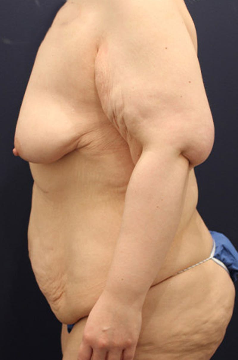 Breast Lift Before & After Gallery - Patient 174150004 - Image 5