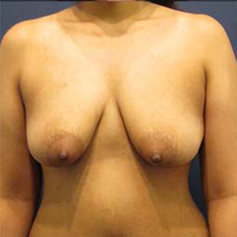 Breast Lift with Augmentation Before & After Gallery - Patient 174146618 - Image 1