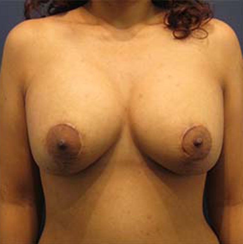 Breast Lift with Augmentation Before & After Gallery - Patient 174146618 - Image 2