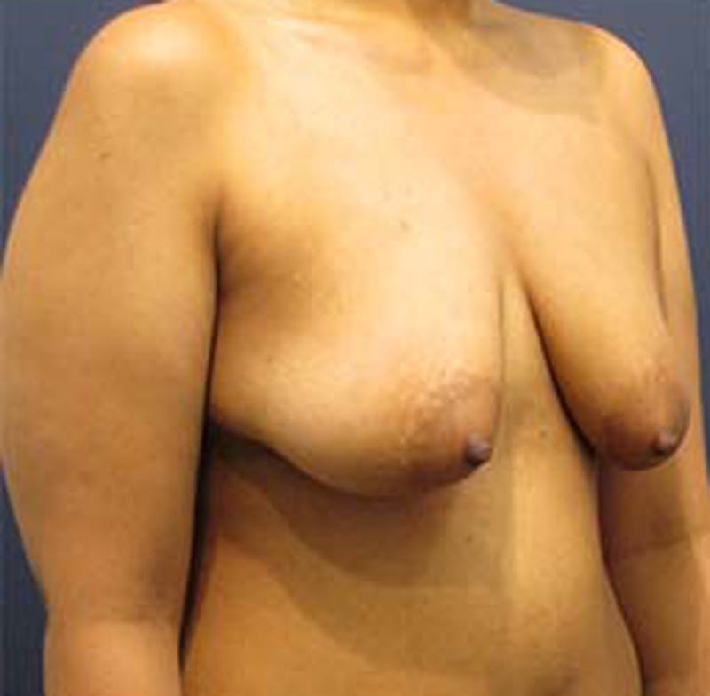 Breast Lift with Augmentation Before & After Gallery - Patient 174146618 - Image 3