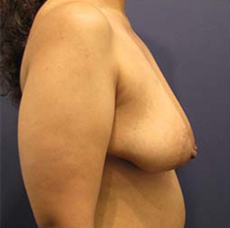 Breast Lift with Augmentation Before & After Gallery - Patient 174146618 - Image 5