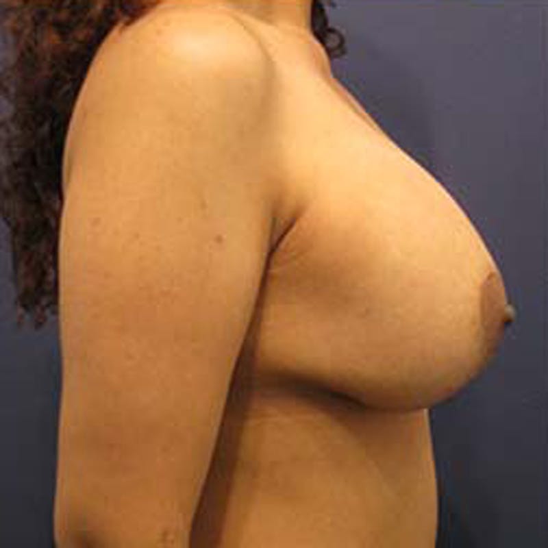 Breast Lift with Augmentation Before & After Gallery - Patient 174146618 - Image 6