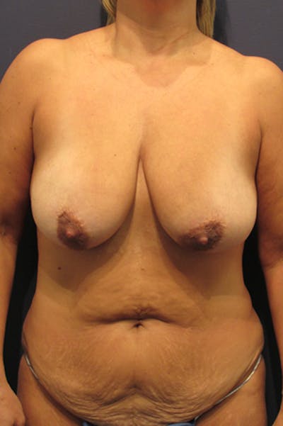 Breast Lift with Augmentation Before & After Gallery - Patient 174147698 - Image 1