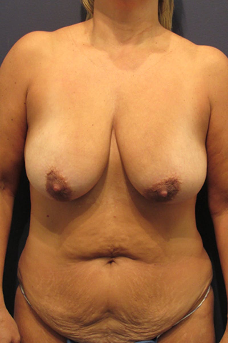 Breast Lift with Augmentation Before & After Gallery - Patient 174147698 - Image 1