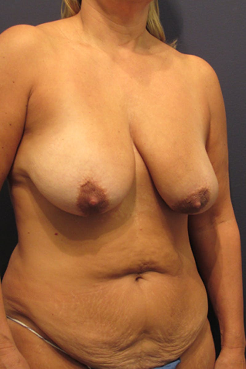 Breast Lift with Augmentation Before & After Gallery - Patient 174147698 - Image 3