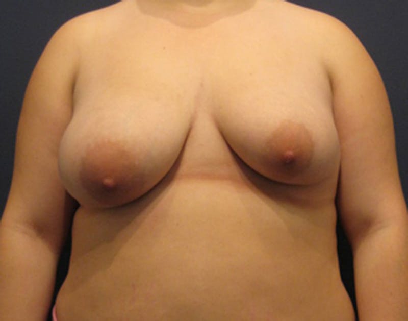 Breast Lift with Augmentation Before & After Gallery - Patient 174147705 - Image 1