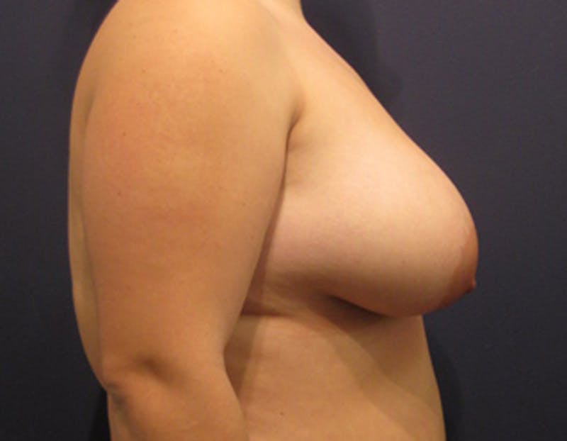 Breast Lift with Augmentation Before & After Gallery - Patient 174147705 - Image 5