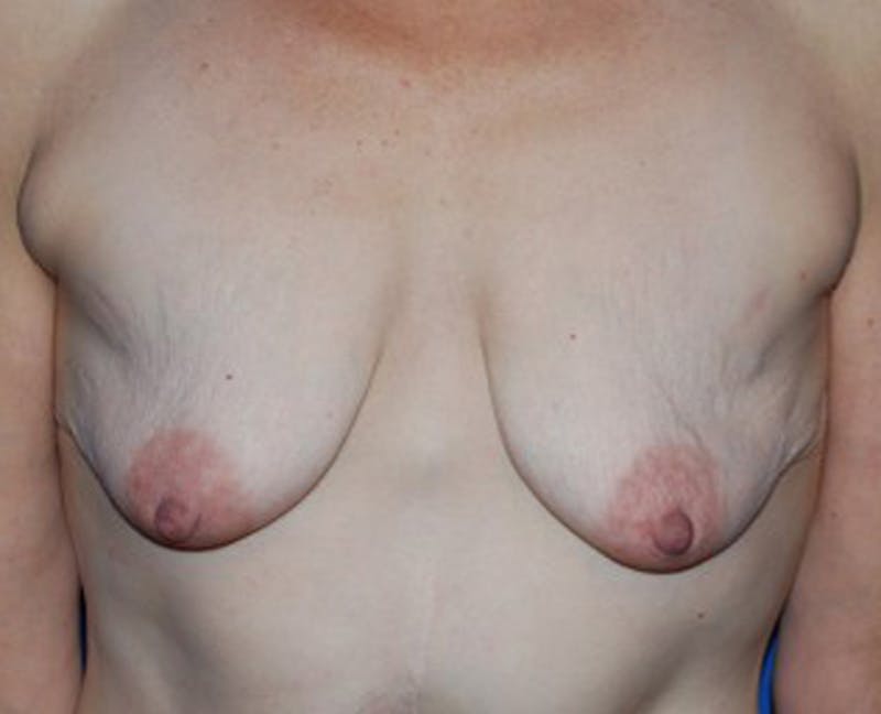 Breast Lift with Augmentation Before & After Gallery - Patient 174147709 - Image 1