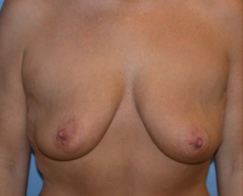 Breast Lift with Augmentation Before & After Gallery - Patient 174147714 - Image 1