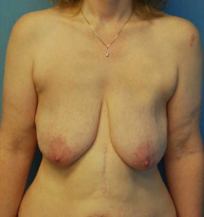 Breast Lift with Augmentation Before & After Gallery - Patient 174148876 - Image 1