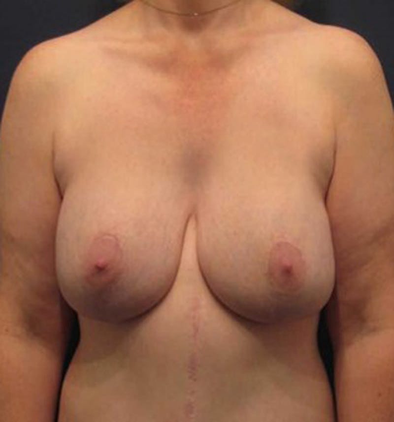 Breast Lift with Augmentation Before & After Gallery - Patient 174148876 - Image 2
