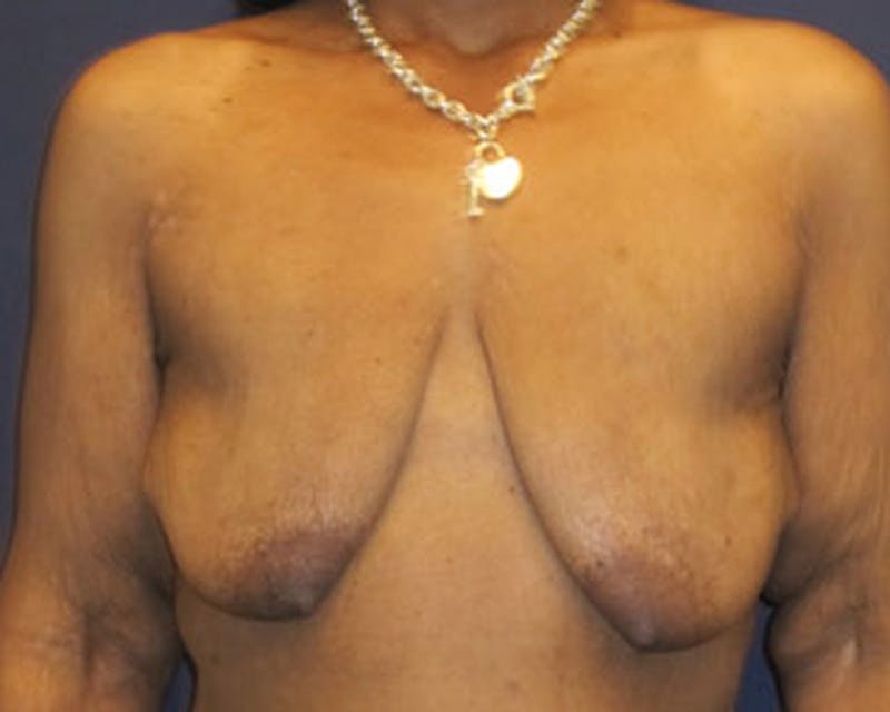 Breast Lift with Augmentation Before & After Gallery - Patient 174148882 - Image 1