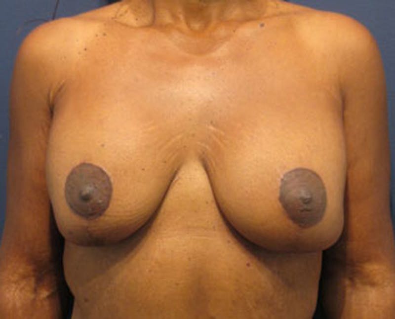 Breast Lift with Augmentation Before & After Gallery - Patient 174148882 - Image 2