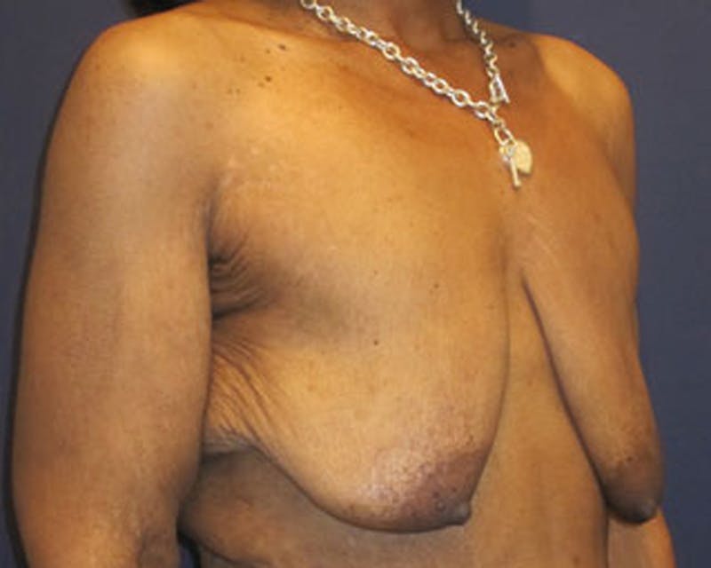 Breast Lift with Augmentation Before & After Gallery - Patient 174148882 - Image 3