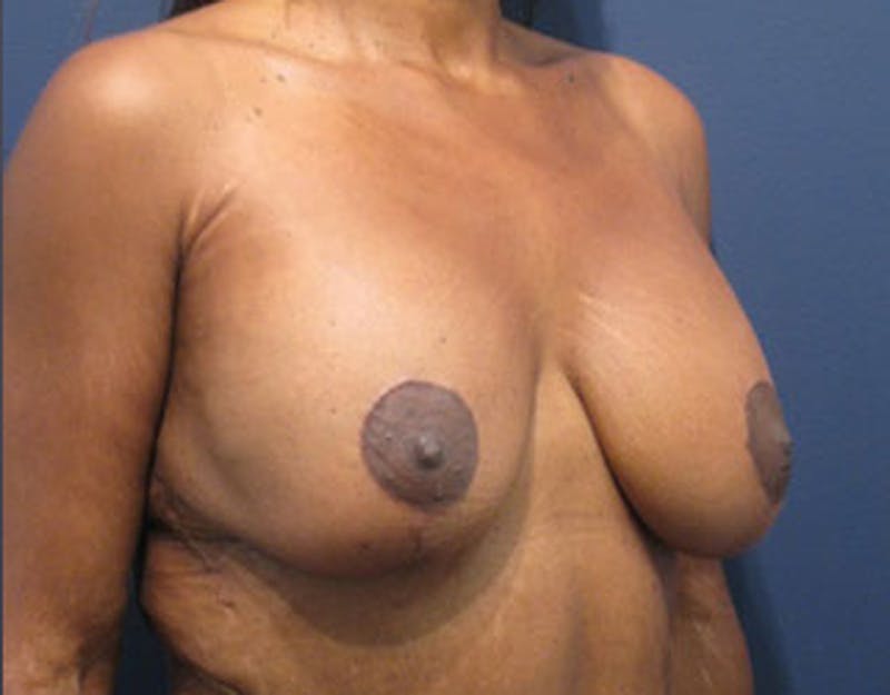 Breast Lift with Augmentation Before & After Gallery - Patient 174148882 - Image 4